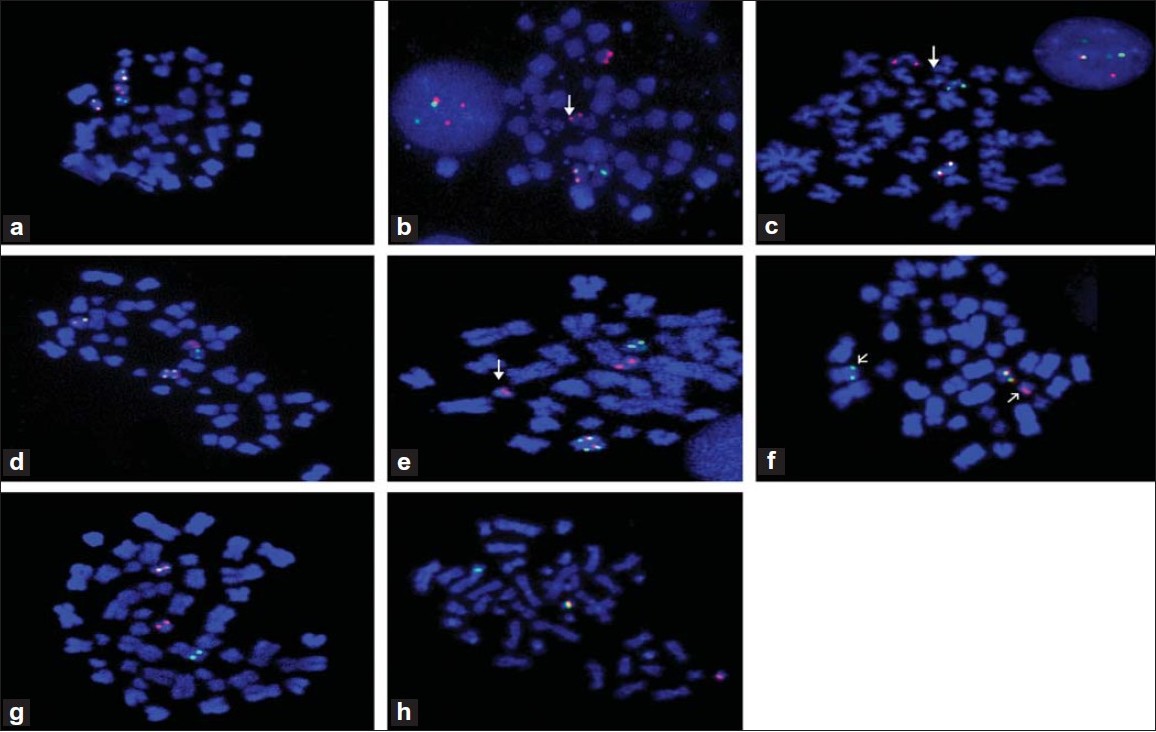 Figure 1: (a) D-FISH with LSI PML– RARA on metaphase cell shows normal PML allele (red signal), normal RARA allele (green signal) reciprocal PML– RARA fusion on der(15) (yellow signal) and der(17) (yellow signal). (b) LSI PML– RARA on metaphase cell shows PML– RARA fusion on der(15) (yellow signal) and residual PML on der(17) (red signal) (white arrow). (c) LSI PML– RARA on metaphase cell shows PML– RARA fusion on der(15) (yellow signal), also shows Aqua CEP 17 normal and der(17) (white arrow). (d) LSI PML– RARA on metaphase cell shows PML– RARA fusion on der(15) (yellow signal) and duplication of PML– RARA on i(17q) (yellow signals). (e) LSI
PML– RARA on metaphase cell shows PML– RARA fusion on der (15) (yellow signal), residual RARA on der(15) (green signal) next to PML– RARA fusion and residual PML signal on der(17) (red signal) (white arrow). (f) Dual color RARA break-apart probe on metaphase cell shows normal RARA allele on 17 (yellow signal), residual RARA on der(17) (red signal) and residual RARA on der(11) at band 11q23 (green signal). (g) Dual color RARA break-apart probe on metaphase cell shows normal RARA allele on 17 (yellow signal), residual RARA on der17 (red signal) and residual RARA on der(11) at band 11q13 (green signal). (h) Dual color RARA break-apart probe on metaphase cell shows normal RARA allele on 17 (yellow signal), residual RARA on der(17) (red signal) and residual RARA on der(2) at band 2p21 (green signal)