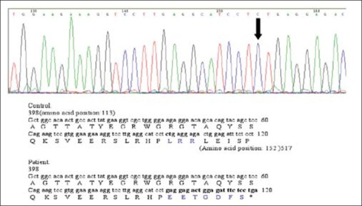Figure 3: Alignment of cDNA sequence from 337 to 456 along with the translation product is shown. 433_434delCT causes shift in the reading frame leading to the introduction of termination codon after the addition of seven novel amino acids