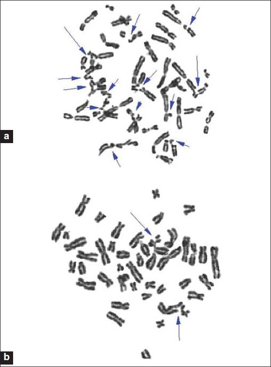 Figure 1: (a) Metaphase spread from a Fanconi anemia patient showing multiple chromosomal breakages induced by mitomycin C (b) Metaphase spread from a healthy individual showing chromosomal breakages induced by mitomycin C.