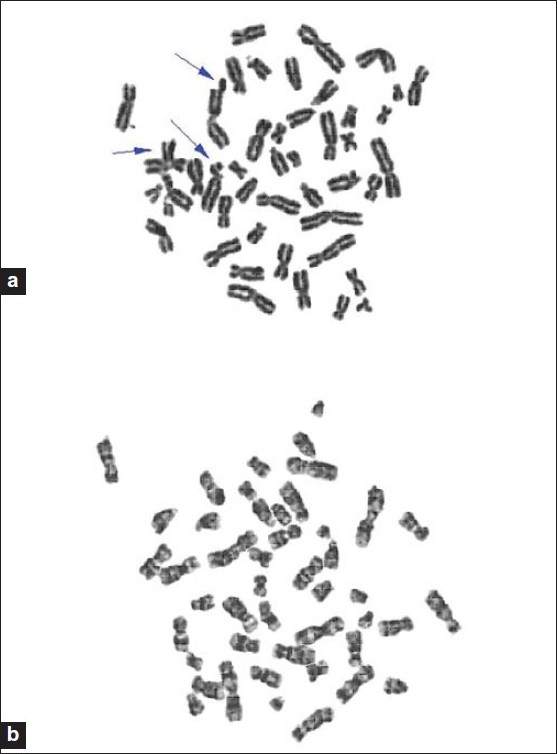 Figure 2: (a) Metaphase spread from a Fanconi anemia patient showing decrease in chromosomal breakages by 0.5 ml of 10% honey aqueous solution against mitomycin C. (b) Metaphase spread from a Fanconi anemia patient showing protective effect of 2ml of 10% honey aqueous solution against mitomycin C induced chromosomal breakage.