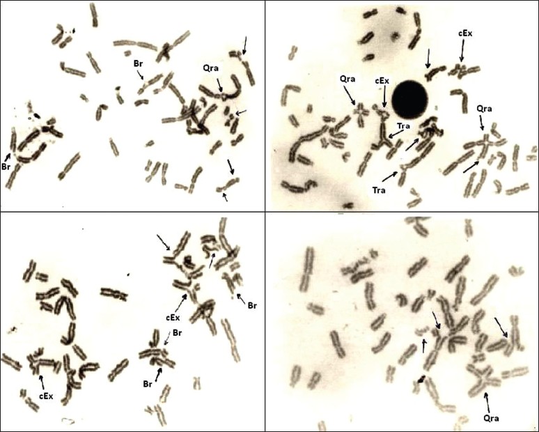 Figure 1: Examples of chromosomal aberrations observed in the lymphocytes of Fanconi anemia patients after mitomycin C treatment. Br = break; Tra = triradial; Qra = quadriradial; cEx = complex exchange