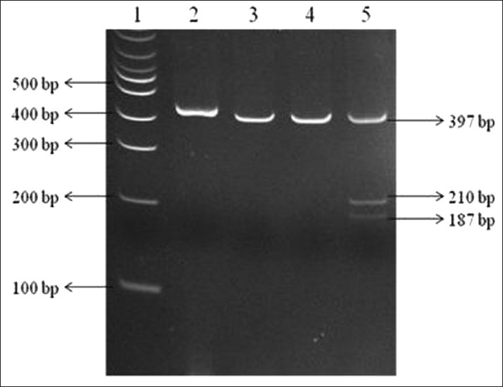 Figure 1: Representative polyacrylamide gel electrophoresis picture of <i>OCT1</i> rs628031 (M408V, 1222A>G) polymorphism. Lane 1 is the 100 bp DNA ladder, Lane 2 is the undigested polymerase chain reaction product, Lanes 3 and 4 show restriction patterns corresponding to the GG homozygous variant and Lane 5 shows the heterozygous variant for AG