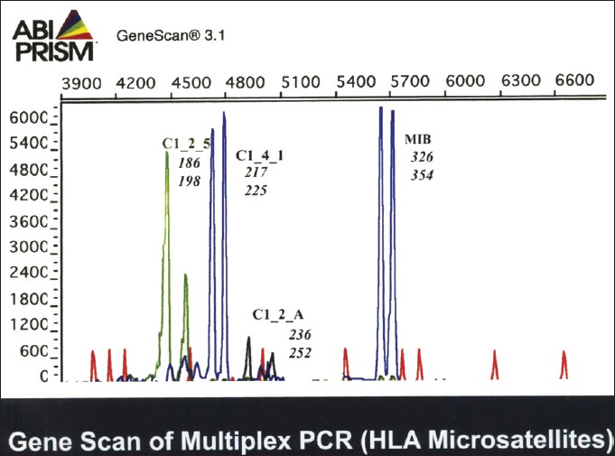 Figure 1: Gene scan depicting allelic frequencies and extend of polymorphism in the test and control cases.
