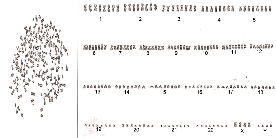 Figure 1: Metaphase and karyotype: Modal karyotype: 176,XXXX,YYYY[06]/46XY