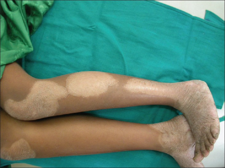 Figure 1: Note hyperkeratotic skin lesions on anterior part of legs