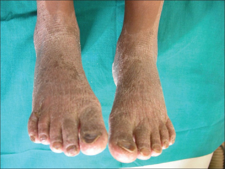 Figure 2: Dry and scaly skin lesions on dorsal surface of feet with dystrophic nails