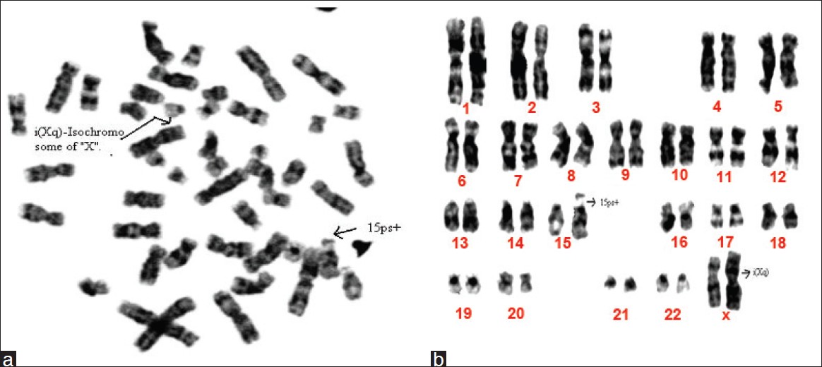 Figure 1: (a) Metaphase of a 14-year-old girl showing 46, XX, 15ps+, i(Xq). (b) Karyotype of a 14-year-old girl showing 46, XX, 15ps+,i(Xq)