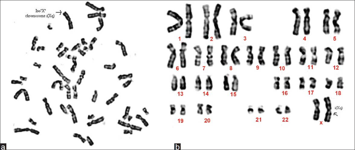 Figure 2: (a) Metaphase of a 15-year-old girl showing 46, X, i(Xq). (b) Karyotype of a 15-year-old girl showing 46, X, i(Xq)