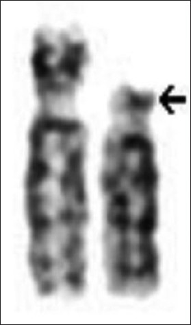 Figure 1: Partial karyotype of the proband- 46,XY,del(4)(p14)