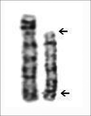 Figure 2: Partial karyotype of proband's mother-46,XX,inv(4)(p14;q35)