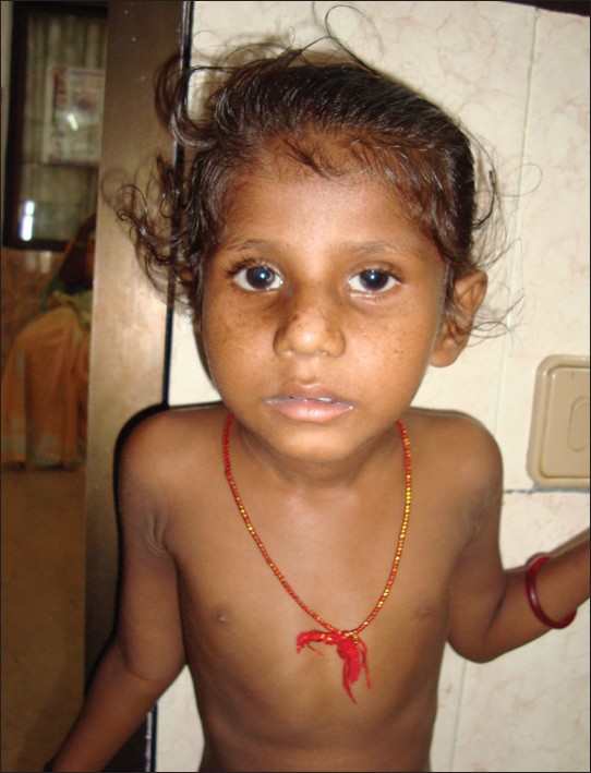 Figure 1: Photograph of a child showing freckles, cachexia, sunken eyes and sparse hair