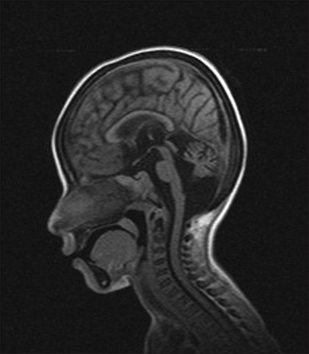 Figure 2: MRI showing enlargement of 4<sup>th</sup> ventricle and atrophy of vermis