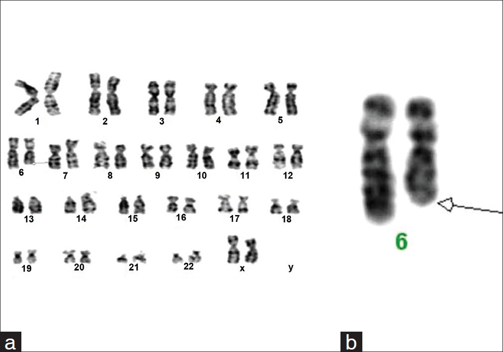 Figure 1: (a) Karyotype 46,XX,del(6)(q24 to qter) showing deletion, (b) Partial karyotype showing 6q 24 to terminal deletion