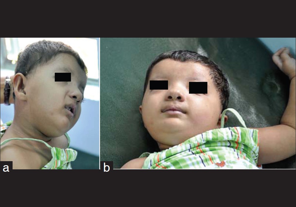 Figure 2: (a and b) Front and side profile showing dysmorphic facies