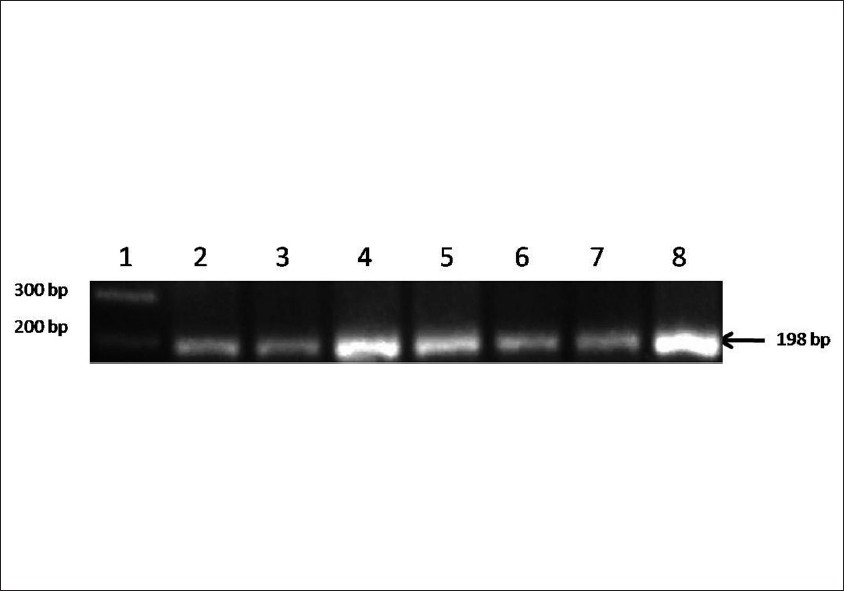 Figure 1: Amplified product of 198-bp for C677T polymorphism