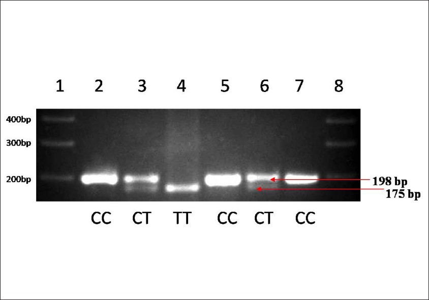 Figure 2: RFLP analysis for the C677T mutation on 198-bp MTHFR PCR products with Hinf I. Wild-type homozygous remains uncut after Hinf I digestion gives one band, mutant homozygous gives two bands (175-bp and 23-bp), and heterozygous gives three bands(198-bp,175-bp, and 23-bp).The figure shows normal CC (lanes: 2, 5, and 7), heterozygous CT (lanes: 3 and 6), and homozygous mutant TT (lane: 4) genotypes