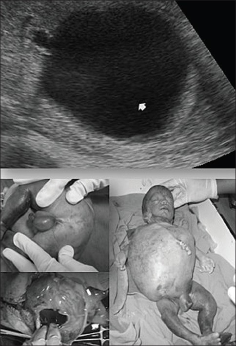 Figure 1: Ultrasound showing large cyst in abdomen. Autopsy picture showing with large abdomen with thinned out abdominal wall. Internal examination showed it to be bladder. Baby had urethral atresia (Case 13)
