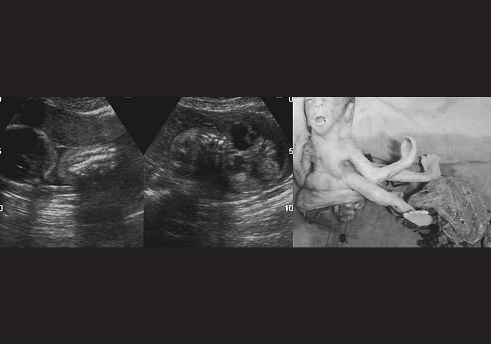 Figure 2: Ultrasound picture of limb body wall defect with enlarged cystic kidney. Autopsy picture confirming the same (Case 19)