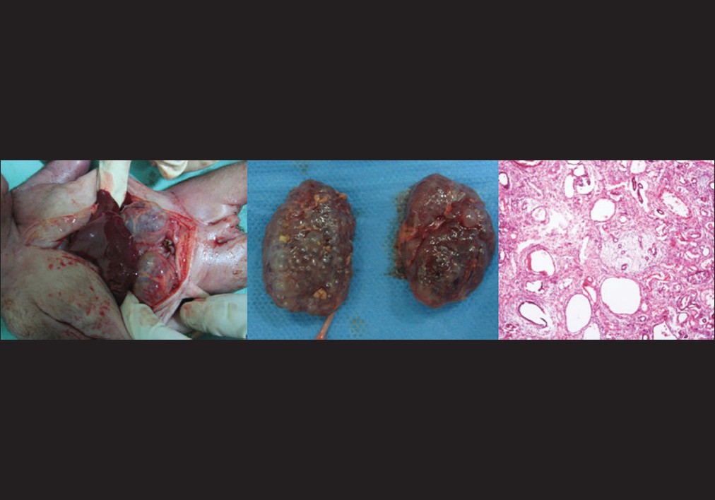 Figure 3: Case 21, with positive family history and bilateral echogenic kidneys on USG, autopsy showing cysts of varying sizes on autopsy, histopathology confirmed it to be multicystic kidney