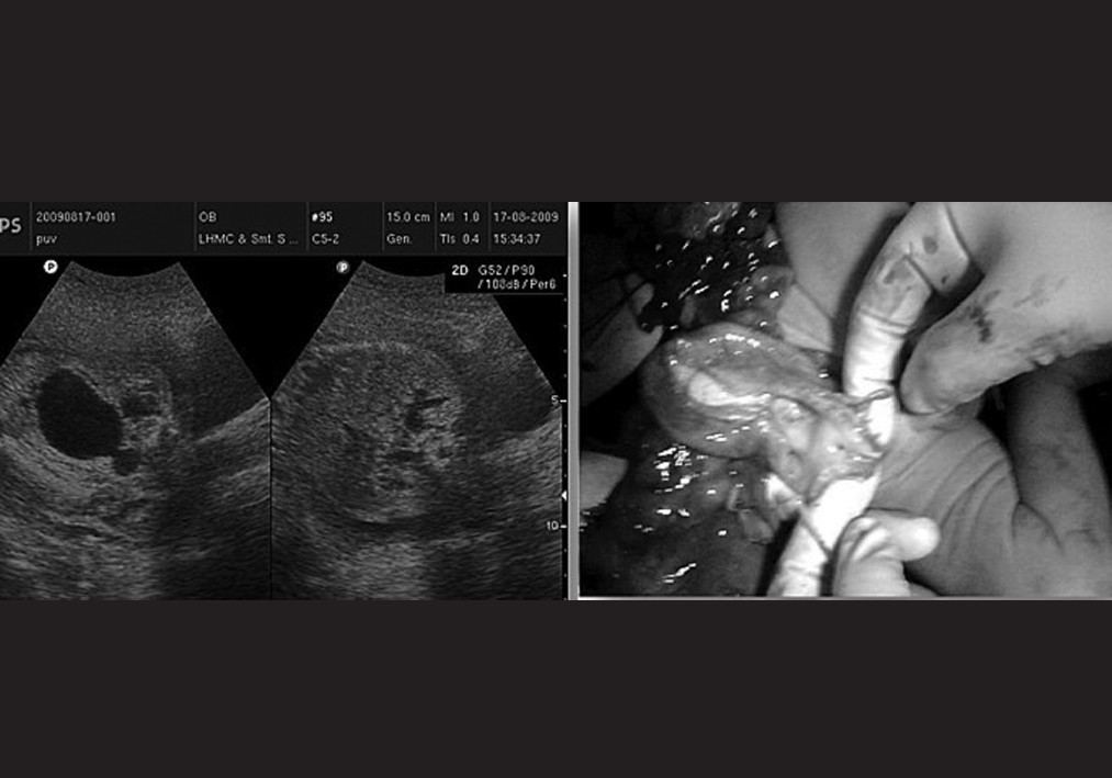 Figure 4: Ultrasound picture of bilateral hydronephrosis with enlarged bladder and typical keyhole sign. autopsy confirming the finding (Case 24)