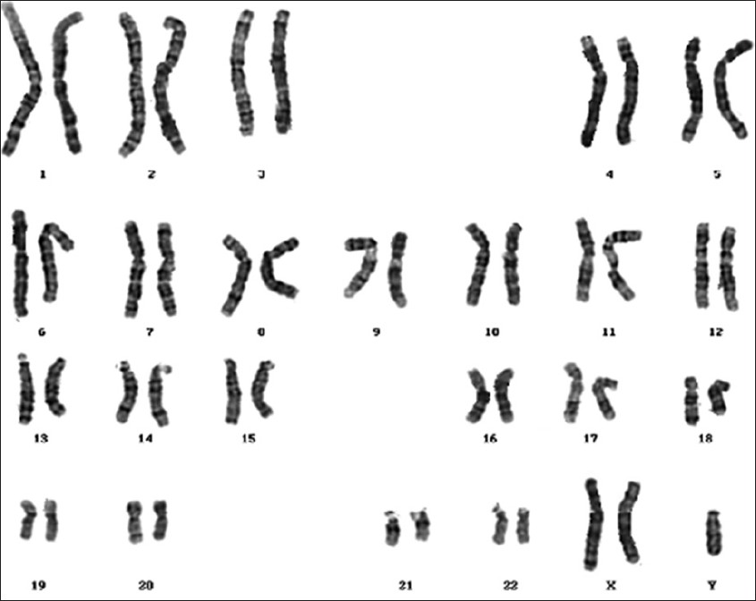 Figure 1: Klinefelter karyotype
