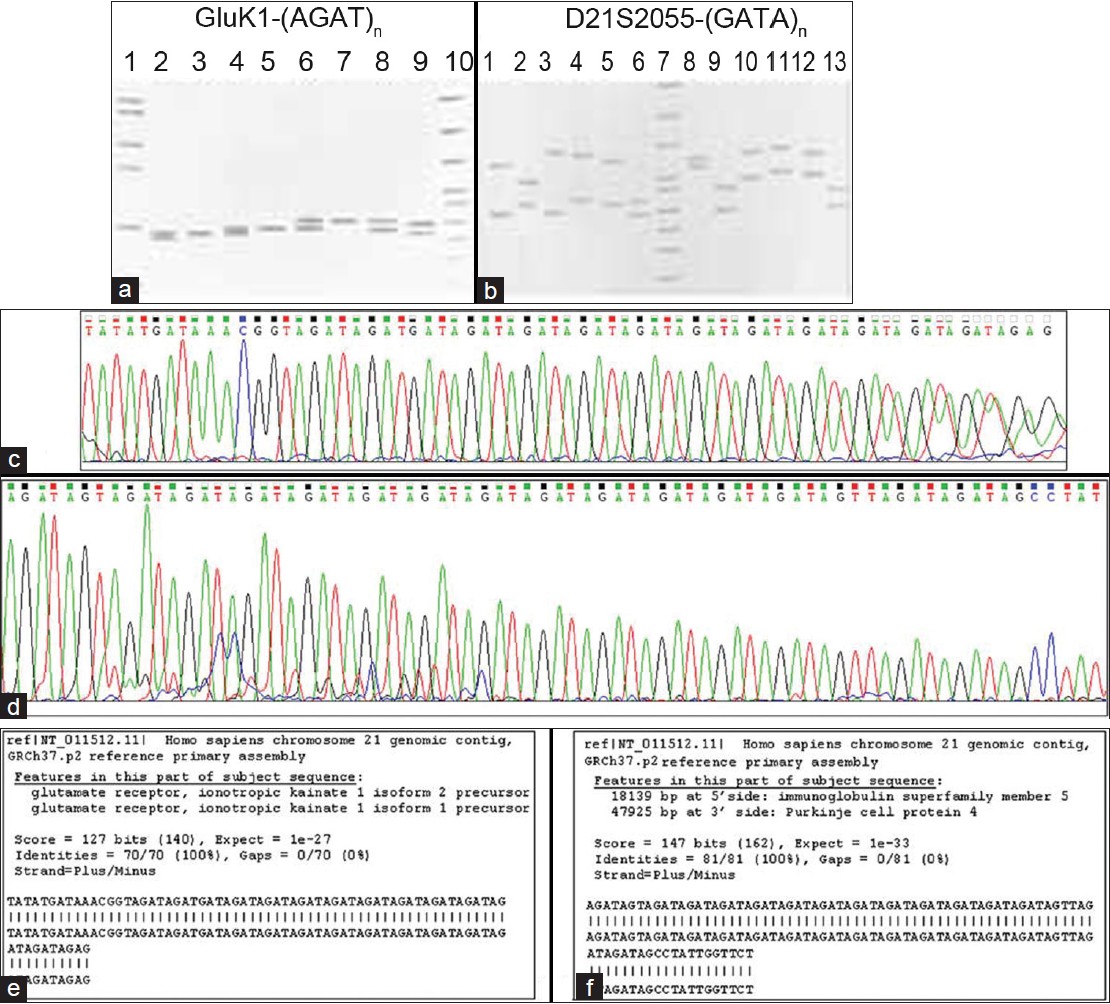 Figure 1 (a,b): (a) Genotypes identified by PCR-based amplification of the GluK1-(AGAT)n polymorphism. 'A' represents followed by polyacrylamide gel electrophoresis allele and subscript denotes number of repeats. Lane-1 ƒÓ X174DNA/HaeIII digest; lane-2 A8A9; lane-3 A9A9; lane-4 A9A10; lane-5 A10A10;lane-6 A10A11; lane-7 A11A11; lane-8 A9A11; lane-9 A8A10; lane-10 ƒÓ X174DNA/HinfI digest. (b) Genotypes identified by PCR-based amplification of the D21S2055-(GATA)n polymorphism. 'A' represents followed by polyacrylamide gel electrophoresis allele. Lane-1 A1A12; lane-2 A3A9; lane-3 A1A16; lane-4 A5A15; lane-5 A3A13; lane-6 A1A4; lane-7 ƒÓ X174DNA HinfI digest; lane-8 A12A14; lane-9 A2A7; lane-10 A9A18; lane-11 A11A19; lane-12 A10A17; lane-13 A2A6
Figure 1: (c) An electropherogram showing the A10 allele of GluK1-(AGAT)n polymorphism. (d) An electropherogram showing the A12 allele of D21S2055-(GATA)n polymorphism
Figure 1: (e) The BLAST data of A10 allele of GluK1-(AGAT)npolymorphism. The data indicates % match and expect value of the given sequence. (f) The BLAST data of A10 allele of D21S2055-(GATA)npolymorphism. The data indicates % match and expect value of the given sequence