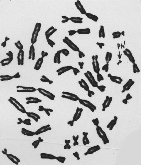 Figure 1: Metaphase plate showing the abnormal Ph1 chromosome (microscope photograph)