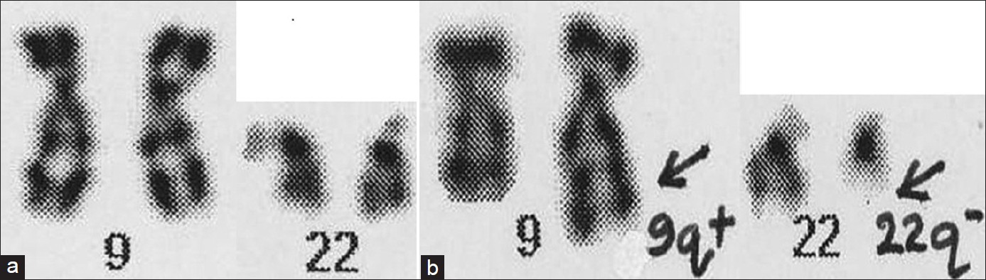 Figure 2: (a, b) A partial karyotype of chromosomes 9 and 22 from a normal individual (a) and from a CML patient (b) showing a reciprocal translocation in between chromosomes 9 and 22 (cytovision photograph)