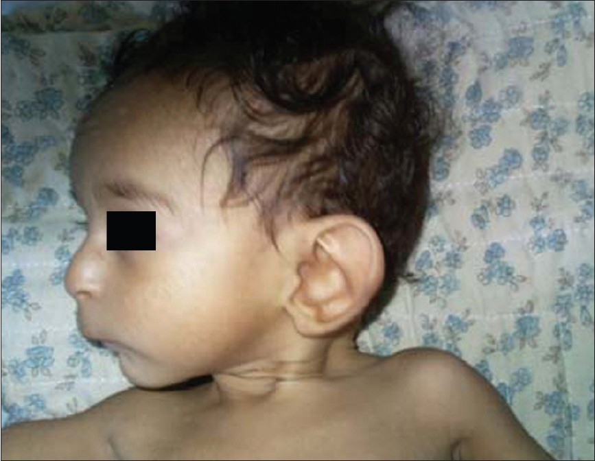 Figure 1: Microcephaly, large and low-set ears, bulbous nose, retromicrognathia
