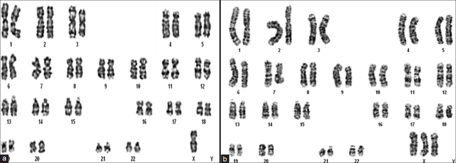 Figure 1: Karyotype of a female with (a) 45, XO and (b) 47, XXX chromosomal constitution