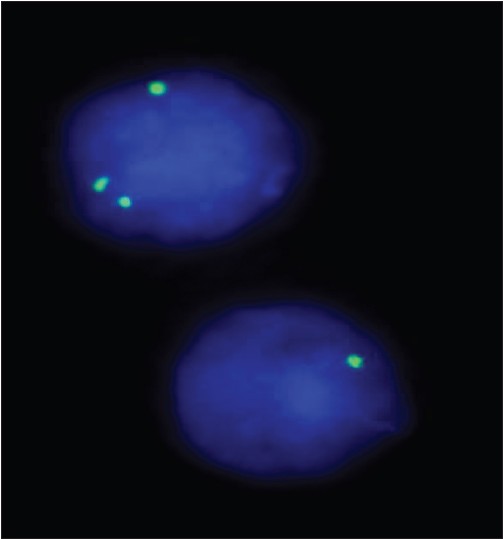 Figure 2: Fluorescent in situ hybridization analysis revealed 3 green signals in some cells and one green signal in others, confirming the presence of mosaicism