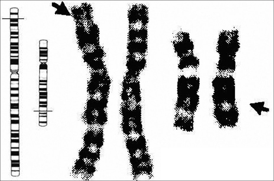 Figure 2: Photographs of normal and translocated chromosomes numbers 2 and 12, displaying also
schematic representation of the breakpoint positions