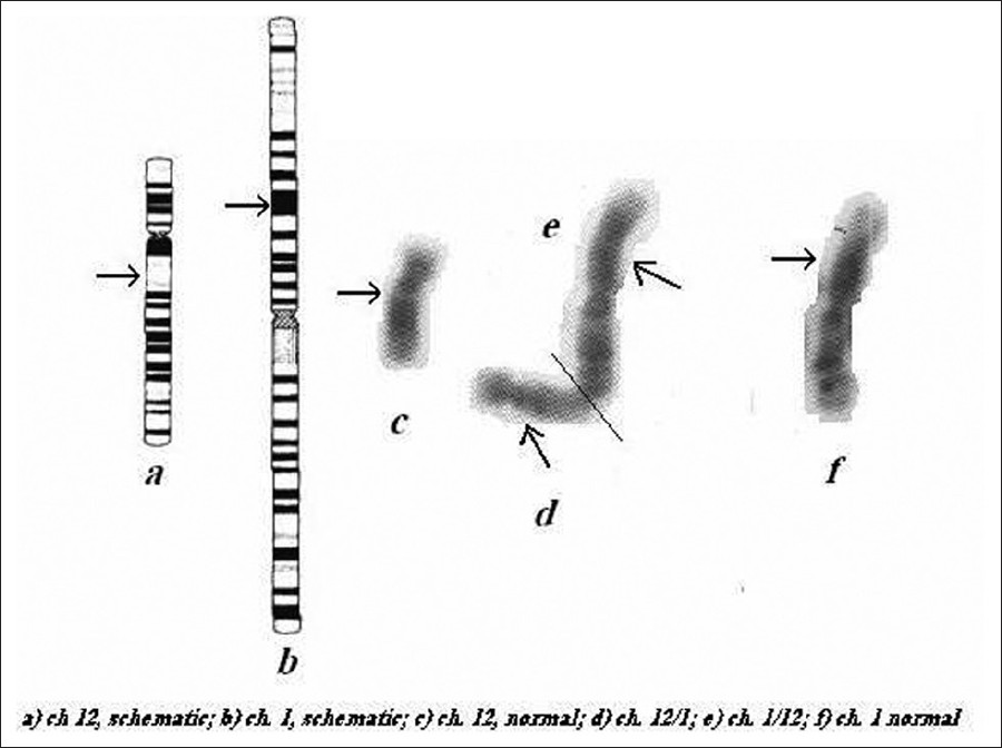Figure 4: Photographs of normal and translocated chromosomes numbers 1 and 12, displaying also
schematic representation of the breakpoint positions