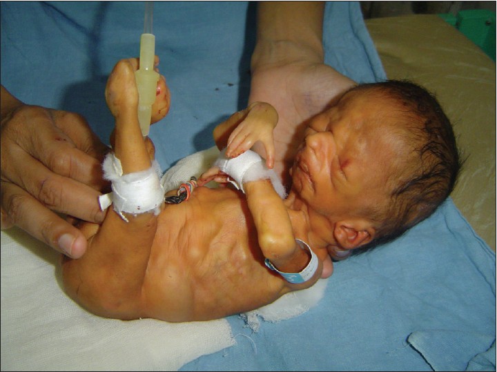 Figure 1: Neonate with features of Malden-Walker
syndrome