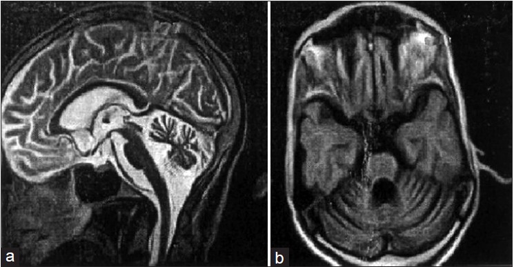 Figure 2: (a) MRI of 40 years old SCA1 patient II9. Strictly mid-sagittal section, showing normal Fundus and diffused cerebellar atrophy and preserved brainstem, (b) Image on axial section through the pons and the cerebellum. The cerebellar vermis and cortex are atrophied