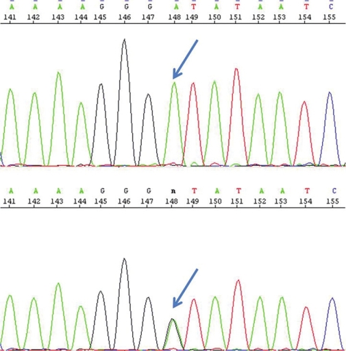 Figure 1: Electropherogram showing homozygosity (top) in the child and heterozygosity (bottom) in the mother for the mutation c.833G>A indicated by arrow