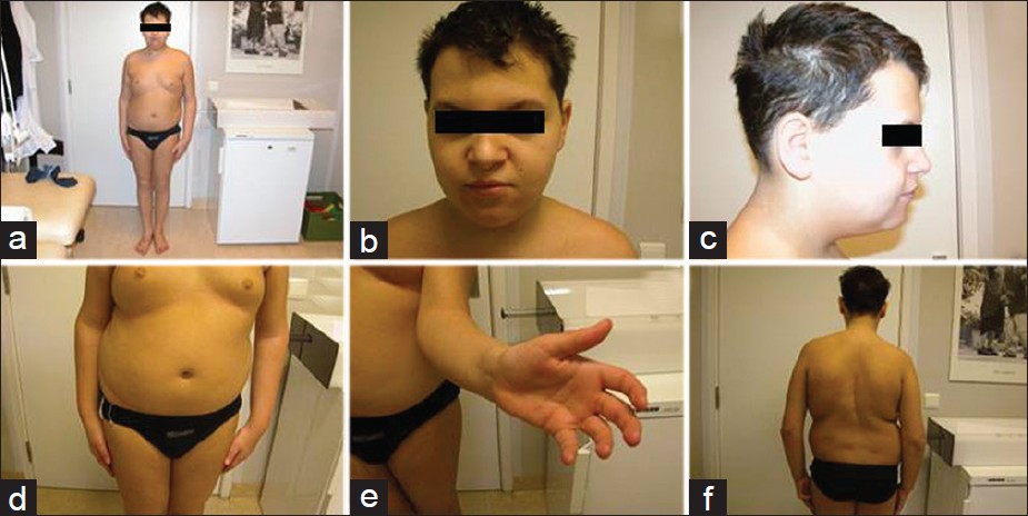Figure 1: Full (a), frontal and lateral (b, c) views of the patient. (d) Note the gynecomastia and morbid obesity. (e) Limitation of supination. (f) Scoliosis