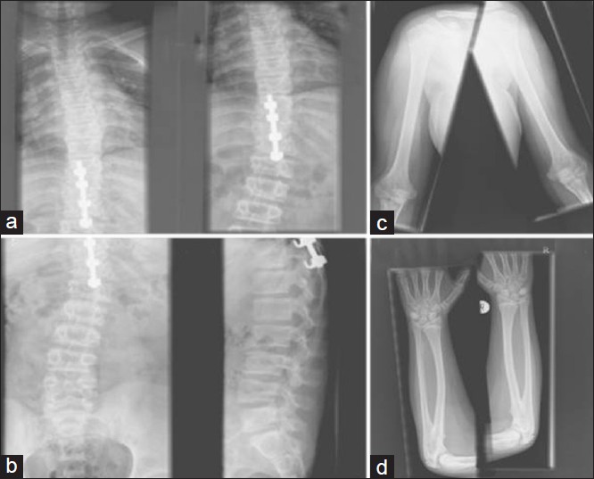 Figure 2: Postero-anterior radiographs of full spine (a, b). X-rays of left and right upper limbs (c, d)