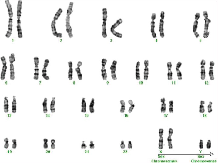 Figure 3: G - banding karyotype of peripheral lymphocytes showing 48, XXYY chromosomes (main cell line)