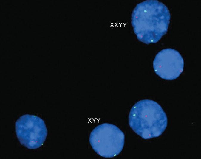 Figure 4: Interphase FISH with centromeric specific probes (Vysis) DXZ1 (green signal) and DYZ3 (red signal) showing XYY and XXYY lymphocyte nuclei