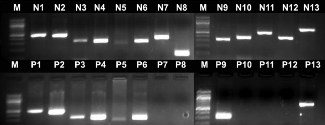 Figure 1: First row, lane 2-9, PCR products for STS markers sY84, sY86, sY127, sY134, sY254 and sY255, lane 11- 15, PCR products for STS markers sY116, sY1191, sY1291, sY1206 and sY1201, amplified from DNA of normal man. Second row, PCR products from patient DNA showing AZFc deletion and b2/b4 re-arrangement