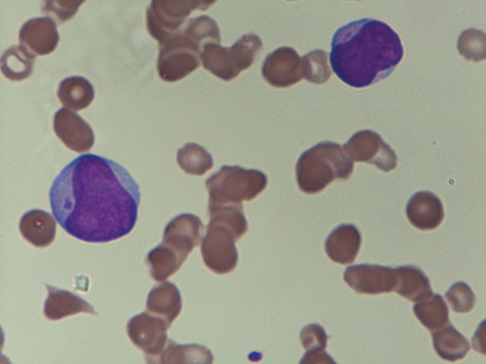 Figure 1: Peripheral smear of an AML-M2 case showing blast with Auer rods