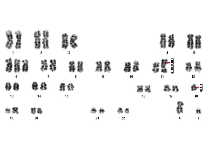 Figure 4: Karyotype of AML M2 case showing 46,XY, + 6,t(11;18)(p11.2;q11.2)
