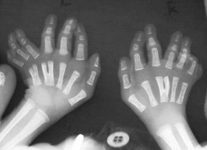 Figure 1: X rays of the hands showing Y-shaped right third, left fourth, and left fifth metacarpals