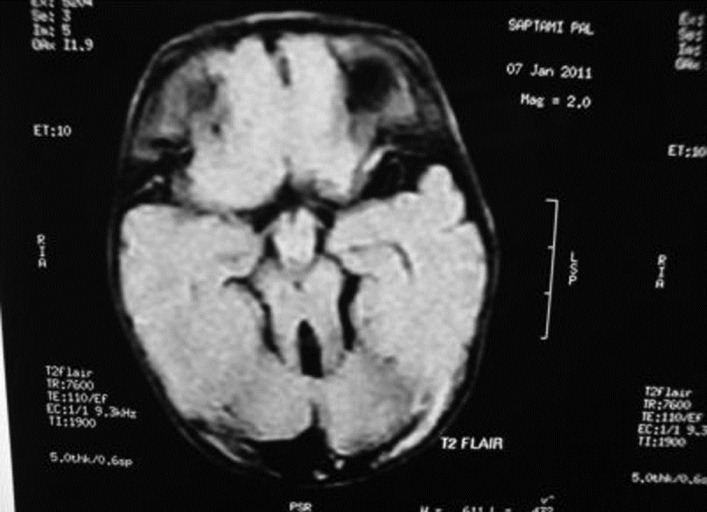 Figure 2: MRI-brain (T2 FLAIR) showing cerebellar vermis hypoplasia with the 
