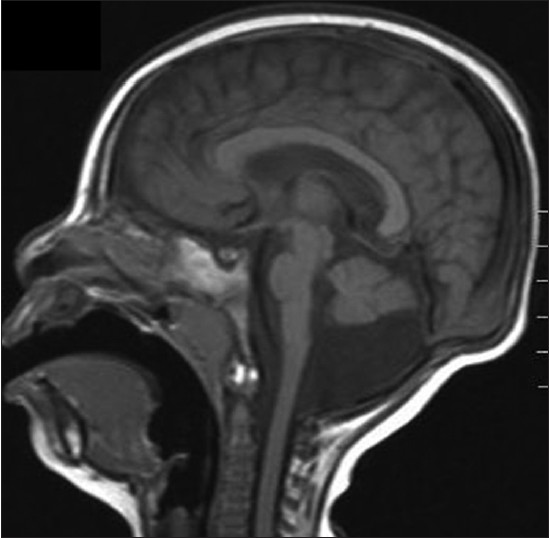 Figure 1: T1 - weighted sagittal image of a 2 - year - old girl. Note the hypoplastic pons and cerebellum with normal appearance of the corpus callosum