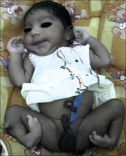 Figure 1: Photograph of the newborn showing deformed lower limbs, normal upper limbs, and darkly pigmented genitalia