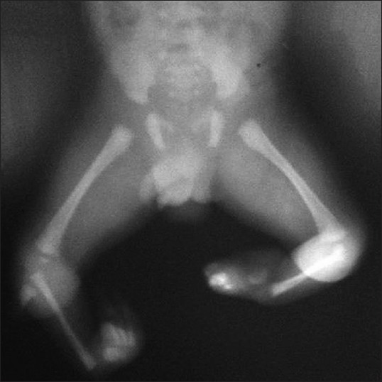 Figure 2: X - ray showing normal hip joint, normal lower end of femur, complete absence of both tibiae with small cartilaginous anlage, and presence of fibula on both legs. Both the right and left foot had three tarsal bones, two metatarsals, and three toes each having two phalanges each