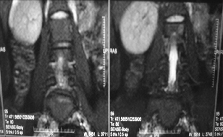 Figure 1: Magnetic resonance imaging abdomen showing absent uterus and vagina. Absent left kidney. Grade-I spondylolisthesis with bilateral spondylosis at L5-S1 level