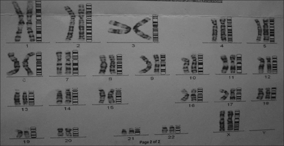 Figure 3: Karyotype study shows (46, XX) chromosome